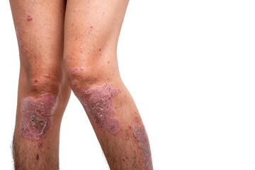 Psoriasis is that knee on white background.