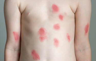Red rash on the body of child. Monkeypox new disease dangerous over the world. Patient with Monkey...
