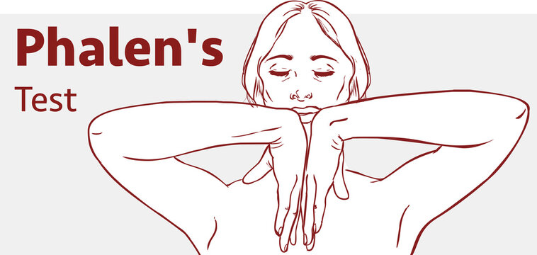 Stock Illustration of Phalen's Test