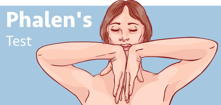 Stock Illustration of Phalen's Test