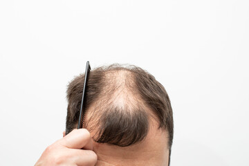 Male pattern baldness how to deal with it