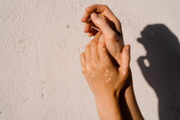 Vitiligo skin pigmentation on the hands of woman. Skin seasonal diseases.