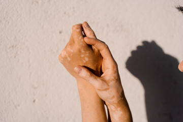 Vitiligo skin pigmentation on the hands of woman. Skin seasonal diseases.