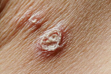 Scabs from inflammatory skin diseases