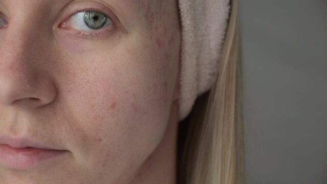 Woman with post acne scars. Skin health. 