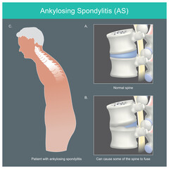 Ankylosing spondylitis. Human spine deformities from inflammation and can cause some of the spine to fuse.. - obrazy, fototapety, plakaty