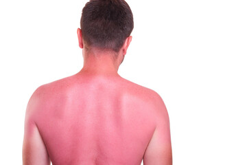 Man with sunburnt back on white background