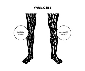 Varicose veins treatment