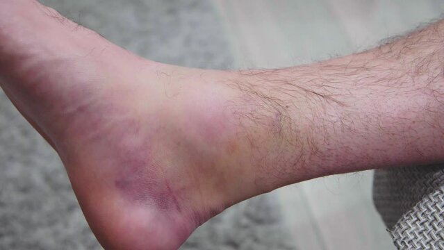 Ankle injury with dislocation and sprains. Fracture or Leg sprain injury of young sports man. 