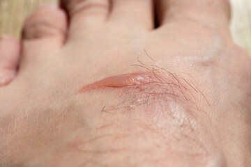 Close up of a blister on a mans foot