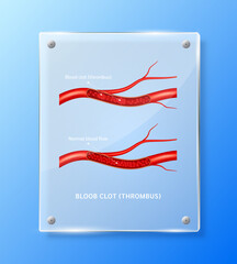 Blood clot (thrombus) in human blood vessels inside square translucent glass panels for pharmacy advertisement. Poster banner design for clinics, hospital. Medic science concept. Realistic 3D Vector.