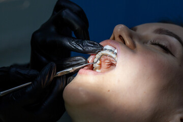 Installing a retainer after wearing braces. The process of removing braces.Beautiful woman in...