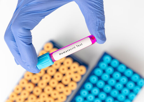 Biochemistry Blood sample for Hematocrit, HTC, MCV test