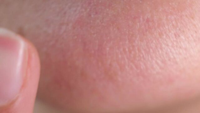 Human skin. Close up. common skin diseases include: Acne, blocked skin follicles that lead to oil, bacteria and dead skin buildup in your pores.