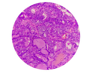 Thyroid cancer: Microscopic image of Metastatic papillary carcinoma of thyroid, central lymph node.