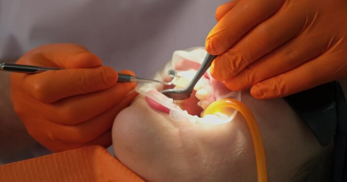 dental treatment and oral care, work of dentist close-up, wide open mouth of patient close-up during restoration of teeth in stomatologist office with very bright lamp illumination.
