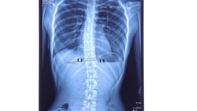 X ray showing scoliosis of the lumbar spine. Scoliosis is an abnormal lateral curvature of the spine. Zoom in 4k