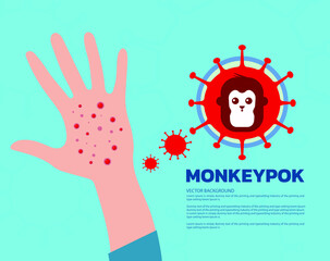 Monkeypox 2022 virus symptoms, Monkeypox virus epidemic virus spreads from animals