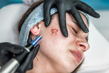 Cosmetologist making painful mesotherapy injection with dermapen on face for rejuvenation on the...