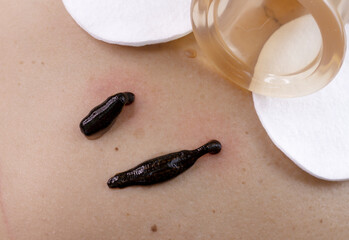 Selective focus on one of the leeches. the leech sucks blood from the skin . bloodletting procedure