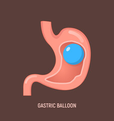 Gastric balloon weight loss intragastric surgery. Stomach gastric balloon operation vector icon - obrazy, fototapety, plakaty