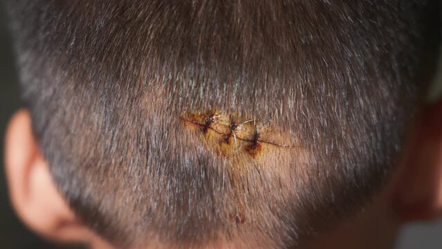 The lacerated sutured wound of kid back head which suture by nylon suture about 3 stitches at the emergency room of the hospital, Medical care of the surgery lesion on the head, children of Accident