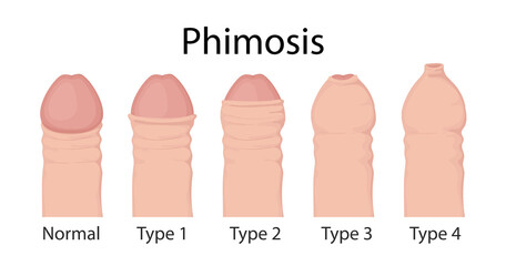 Types of phimosis. penis medical vector illustration. - obrazy, fototapety, plakaty