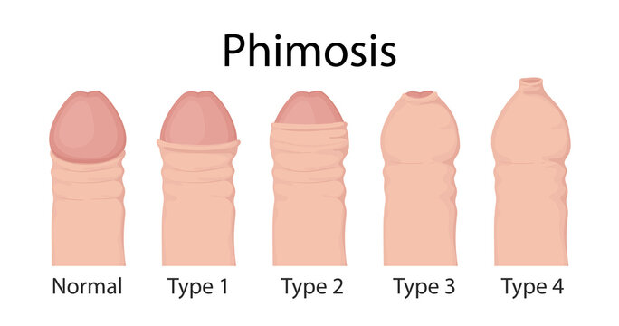 Types of phimosis. penis medical vector illustration.