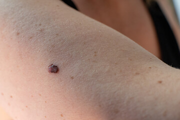 close up of an abnormal mole sign of skin cancer on a woman's arm 