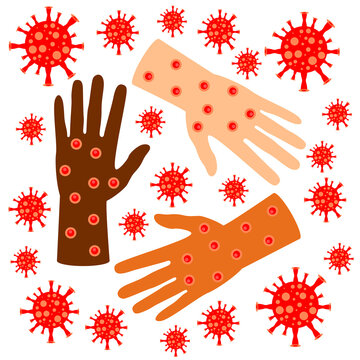 Monkeypox virus, hand in smallpox ulcers. Smallpox