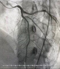 Normal left coronary artery (LCA) angiogram.