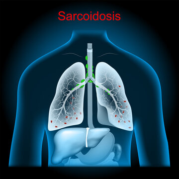 Sarcoidosis. Enlarged lymph nodes in the lungs