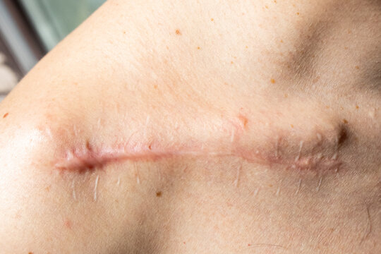 Suture wound after fracture of the right clavicle, one month after surgery, close up image