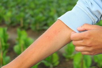 female farmer shows insect bites while working on the farm. problem with mosquitoes on plantations...