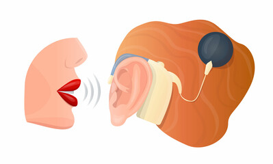 Vector isolated illustration with an ear and a hearing aid, where the sound processor is attached with a pin to the temporal bone and mouth that whispering. Concept treatment of hearing loss, otology.