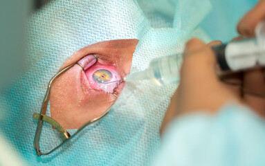 Eye surgery. Surgery to improve vision. Doctor surgeon performs cataract surgery, treatment of...