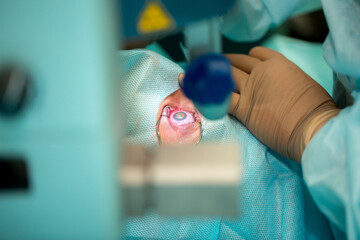 Eye surgery. Surgery to improve vision. Doctor surgeon performs cataract surgery, treatment of myopia. Hospital staff in the operating room. - obrazy, fototapety, plakaty