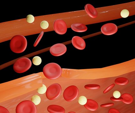 Hemophilia leads to spontaneous bleeding as well as bleeding following injuries or surgery 3d rendering