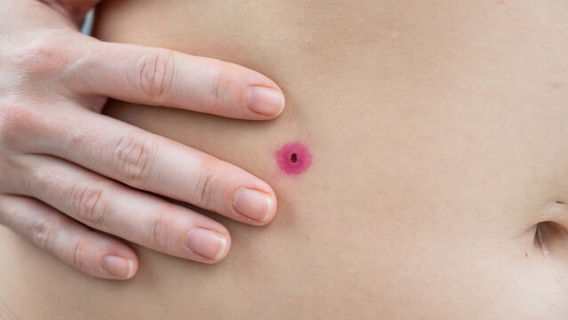 Close-up of a removed wart on a woman's abdomen. Human papillomavirus after burning.