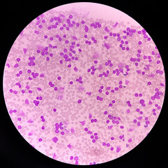 Acute leukemia, peripheral blood smear show most of cell are blast cell with abundant cytoplasm,...