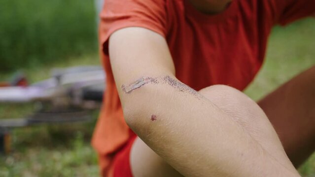 A large bloody beautiful wound on the elbow. Damaged skin. Healing wound with a rough skin crust. Pain from injury. Purulent wound healing. Crash falling from a child's bicycle in the park. injury.