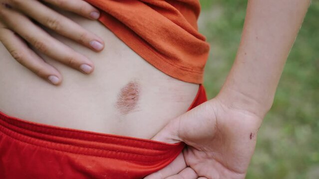 Large bloody purple wound from an abdominal injury. Healing wound, the formation of rough crust on the skin due to sore wound. Pain from hitting and cutting the skin and getting bruised from falling.