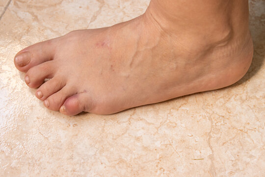 Broken and bruised little toe from blood spill