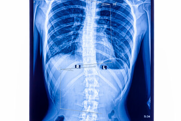 X ray showing scoliosis of the lumbar spine