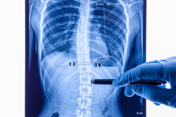 Doctor analyzing X ray of the spine showing scoliosis in the lumbar area - obrazy, fototapety, plakaty