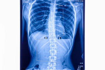 X ray showing scoliosis of the lumbar spine - Powered by Adobe