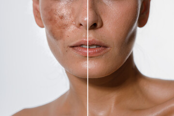 Hyperpigmentation of female skin, close-up of a part of the face on a white background, before and...