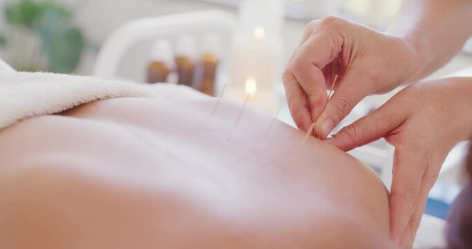 Closeup of acupuncture needles in a patients back. Professional acupuncturist and therapist treating a clients spine in a clinic. Releasing upper back muscle tension with holistic gentle treatment