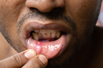 Painful mouth ulcer