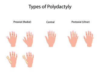 illustration of biology and medical, Types of polydactyly, Symptoms of Polydactyly, polydactyly is an anomaly in humans and animals resulting in supernumerary fingers or toes